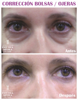 Eliminaci�n Bolsas y ojeras